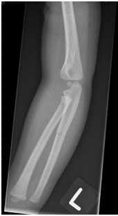 x-ray of arm, details below
