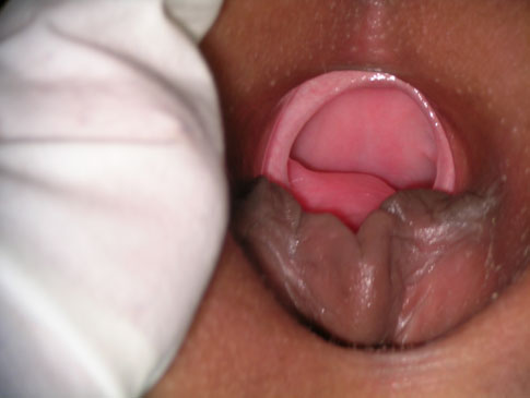 image of hymen, description below